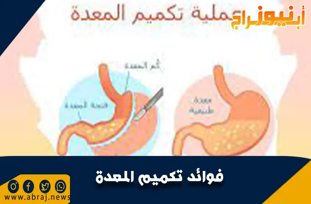 فوائد تكميم المعدة