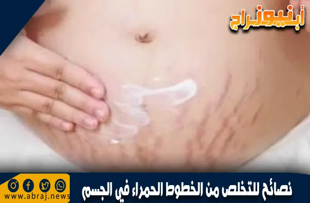 نصائح للتخلص من الخطوط الحمراء في الجسم