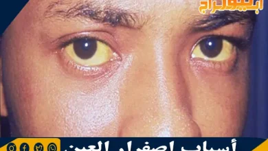 أسباب اصفرار العين وطرق تشخيص وأهم النصائح