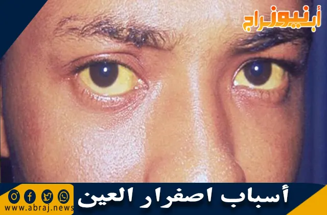 أسباب اصفرار العين وطرق تشخيص وأهم النصائح