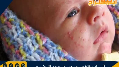أسباب ظهور حبوب في وجه الرضيع
