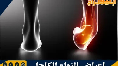 أعراض التواء الكاحل ونصائح علاجه في المنزل