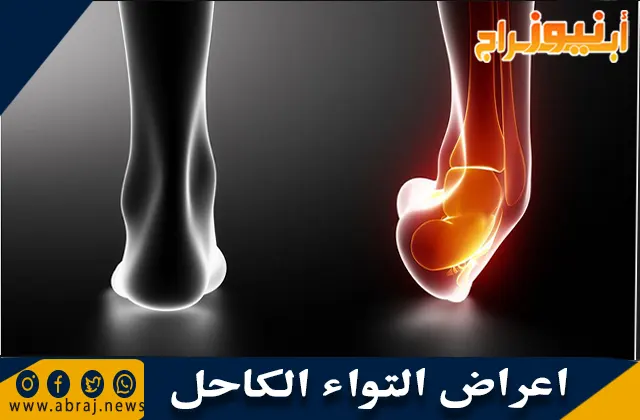أعراض التواء الكاحل ونصائح علاجه في المنزل