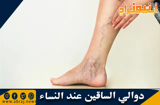 دوالي الساقين عند النساء وأسبابها ونصائح لعلاجها