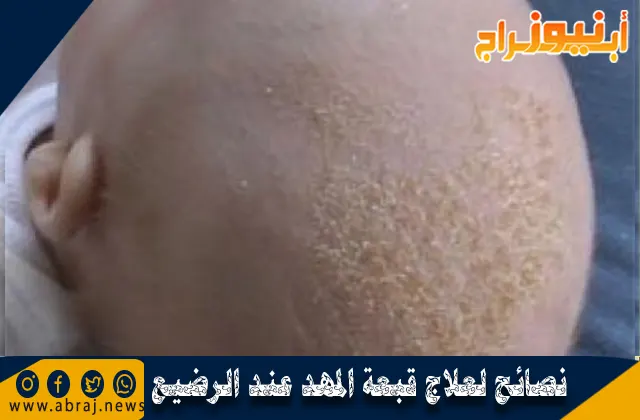 نصائح لعلاج قبعة المهد عند الرضيع