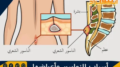 أسباب النواسير وأعراضها ونصائح علاج الناسور 2 أسباب النواسير وأعراضها ونصائح علاج الناسور