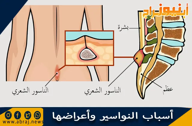 أسباب النواسير وأعراضها ونصائح علاج الناسور