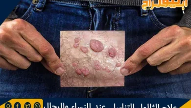 علاج الثالول التناسلي عند النساء والرجال ونصائح للوقاية 12 علاج الثالول التناسلي عند النساء والرجال ونصائح للوقاية