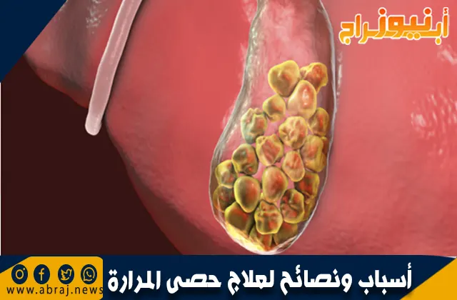أسباب ونصائح لعلاج حصى المرارة
