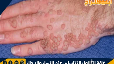 علاج الثالول التناسلي عند النساء والرجال ونصائح للوقاية