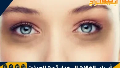 أسباب الهالات السوداء تحت العينين