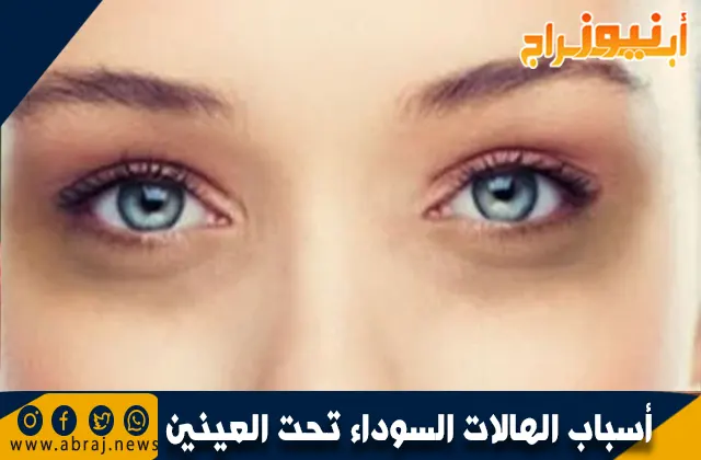 أسباب الهالات السوداء تحت العينين