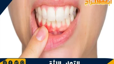 التهاب اللثة 2 التهاب اللثة