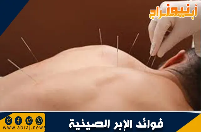 فوائد الإبر الصينية للأعصاب